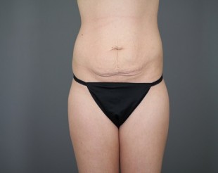 Tummy Tuck Patient 18