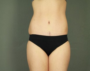 Tummy Tuck Patient 18