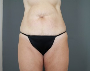 Tummy Tuck Patient 18