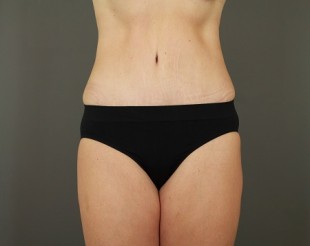 Tummy Tuck Patient 18