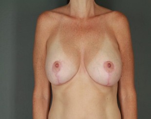 Breast Augmentation with Lift Patient 31