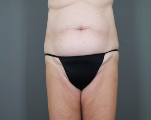 Tummy Tuck Patient 22