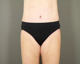 Tummy Tuck Patient 22