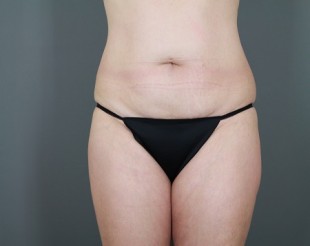 Tummy Tuck Patient 20