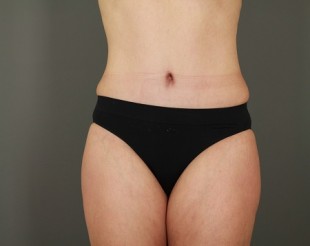 Tummy Tuck Patient 20