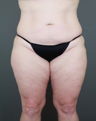 Tummy Tuck Patient 21