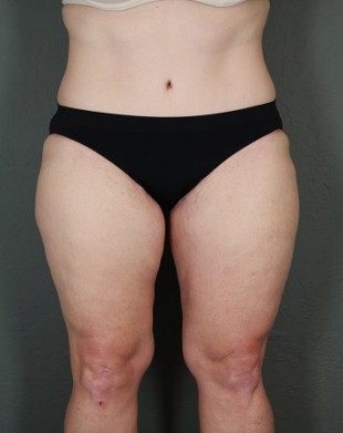 Tummy Tuck Patient 21