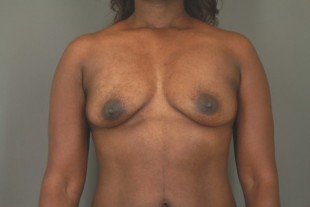 Breast Augmentation 38