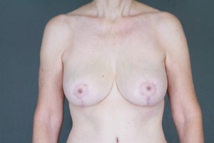 Breast Lift 5