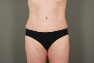 Tummy Tuck Patient 23