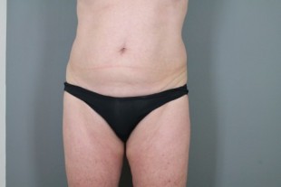 Tummy Tuck Patient 23