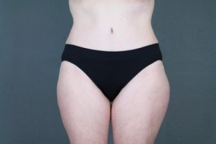 Tummy Tuck