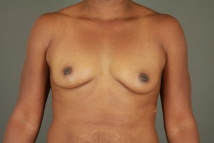 Breast Aug 40