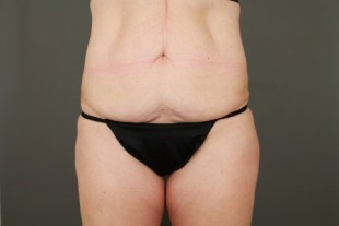 Tummy tuck 10-2