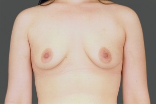 Breast Augmentation 28 2