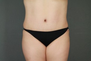 Tummy Tuck 26