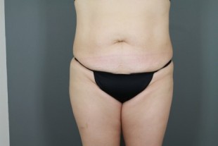 Tummy Tuck 26