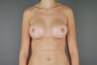 breast augmentation 39