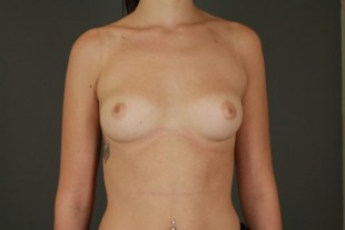 breast augmentation 39