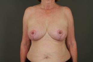 Breast Reduction 4