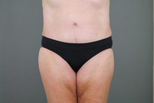 tummy tuck