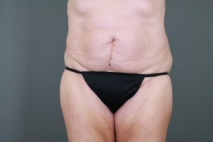 tummy tuck