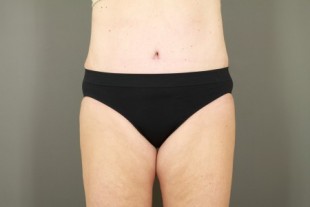 tummy tuck 27