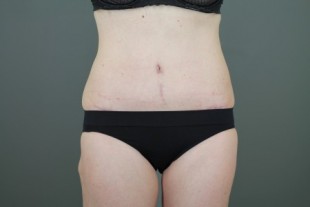 Tummy Tuck 29