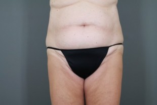 tummy tuck 27