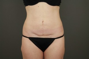 Tummy Tuck 29