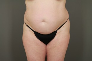 tummy tuck 35