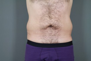 Liposuction