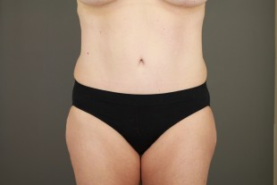 Tummy Tuck 30