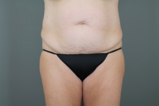 Tummy Tuck 30