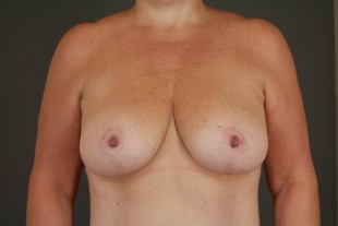 Breast Lift 6