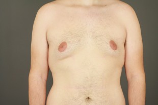 Male mastopexy