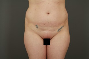 Liposuction 12