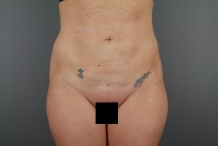 Liposuction 12