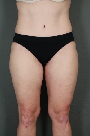 Medial thigh lift