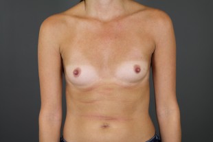 Breast Augmentation 49