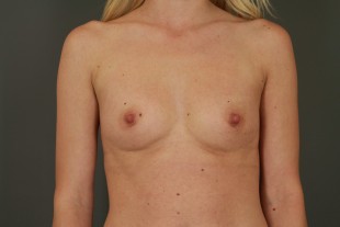 Breast Augmentation 43