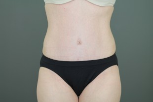 Tummy Tuck 32