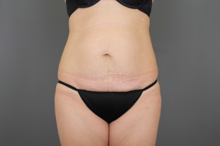 Tummy Tuck 31