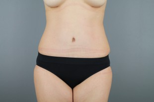 Tummy Tuck 31