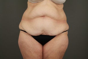 Tummy Tuck 1