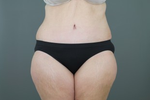 Tummy Tuck 1