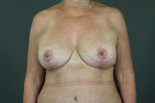 Breast Implant Exchange 11