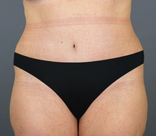 Tummy Tuck 34