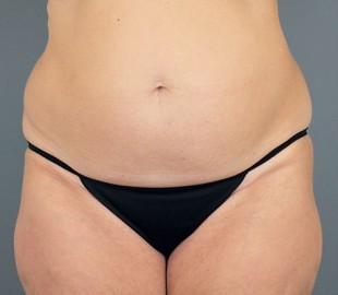 Tummy Tuck 34