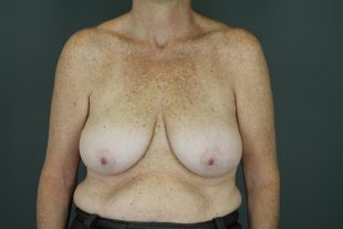 Breast Reduction 15